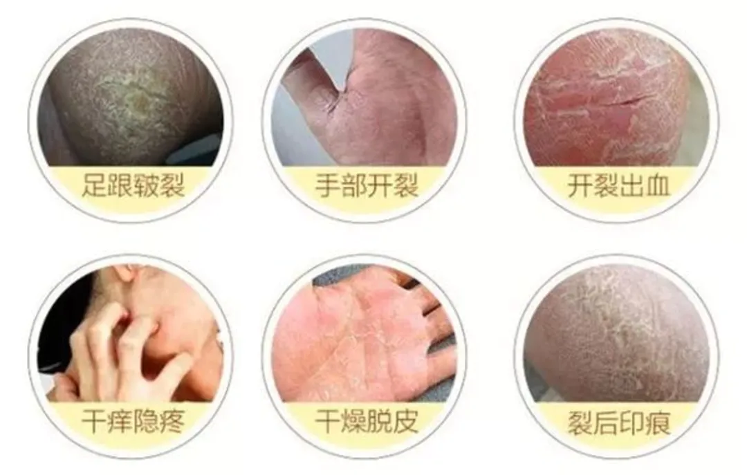 手脚脱皮干裂，泰国古方一抹见效，3天奇迹修复，帮你轻松找回白嫩好皮肤