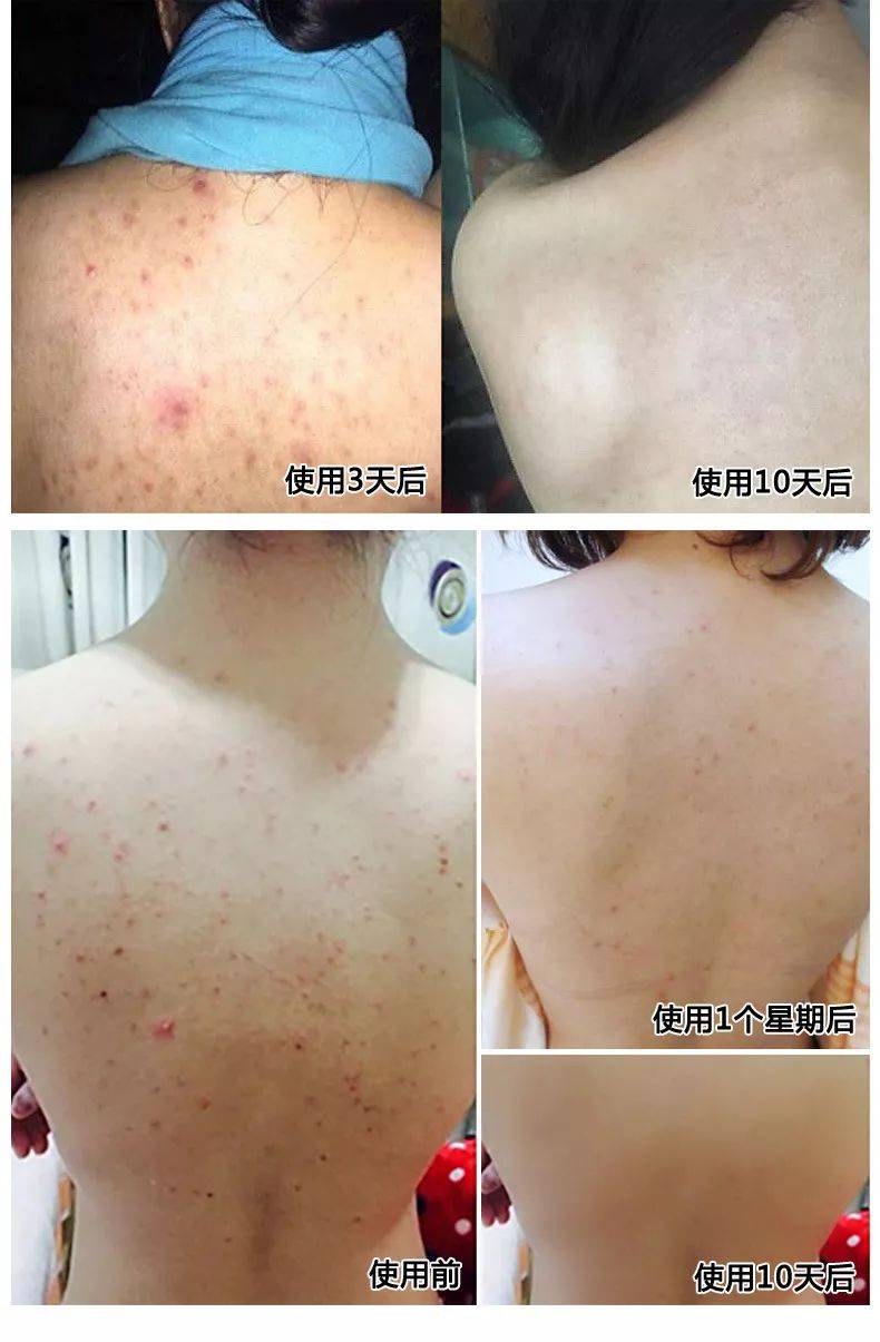 游泳之后鸡皮肤(为什么游泳完皮肤特别好)